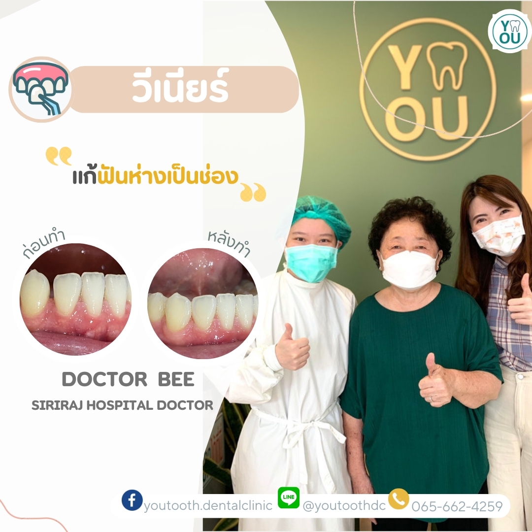 รีวิววีเนียร์