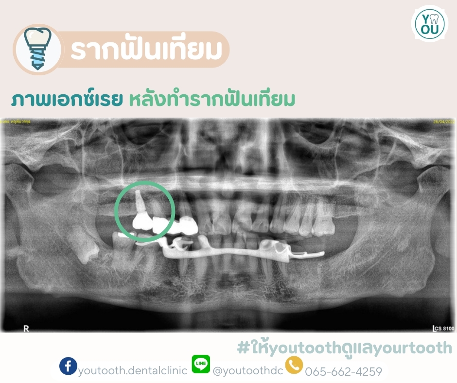 รีวิวรากฟันเทียม