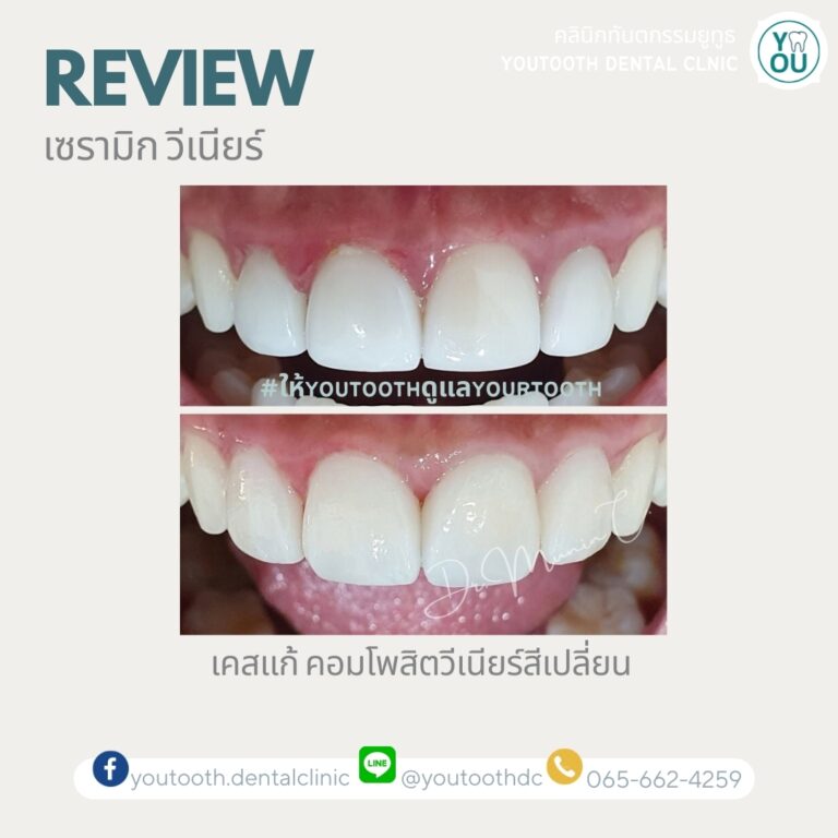 รีวิววีเนียร์