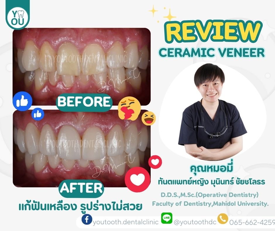 วีเนียร์ราคา