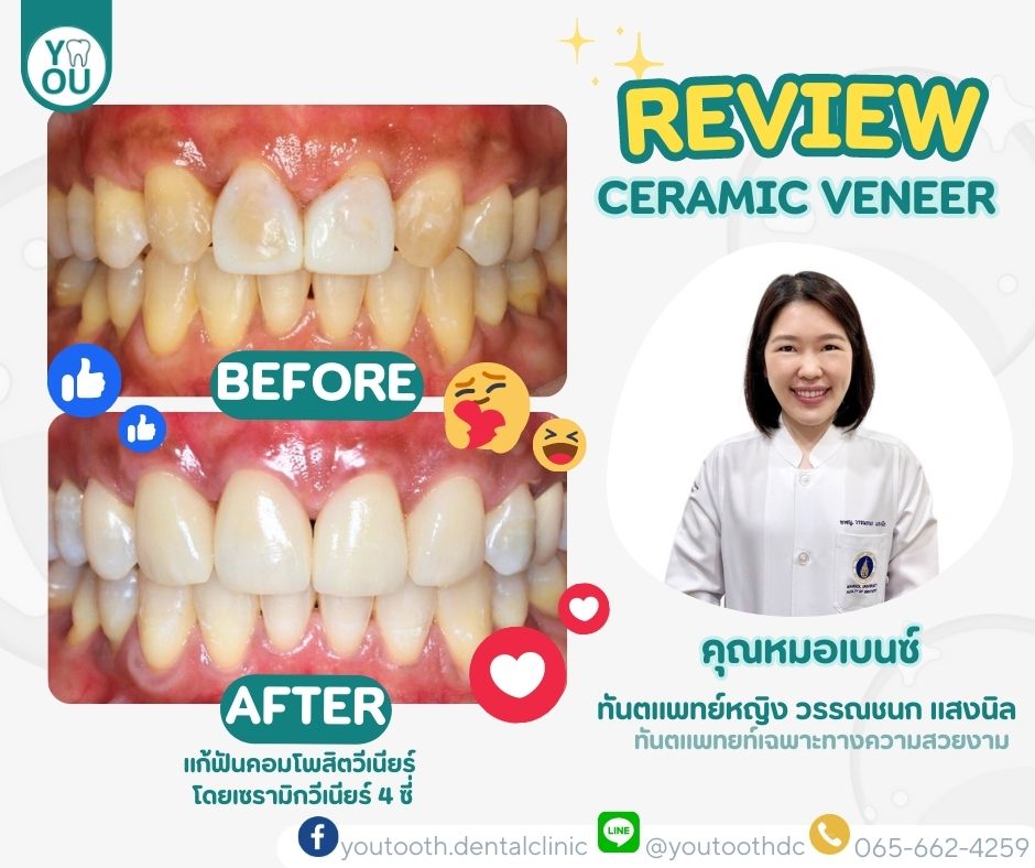 วีเนียร์ราคา