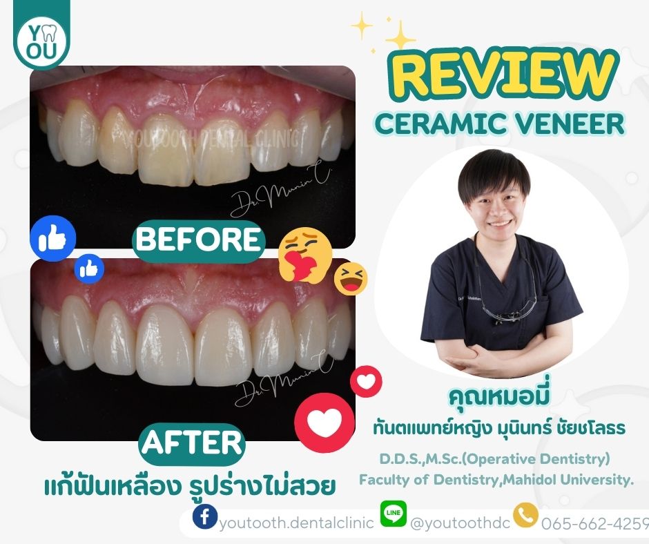 วีเนียร์ราคา