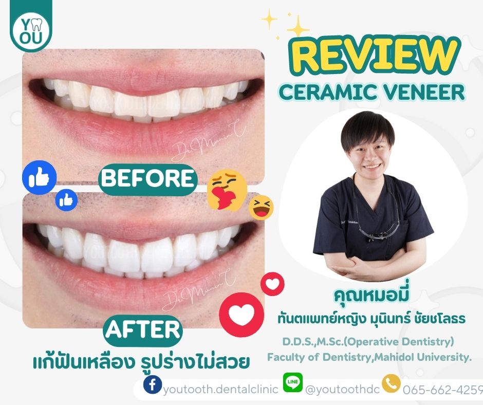 วีเนียร์ราคา