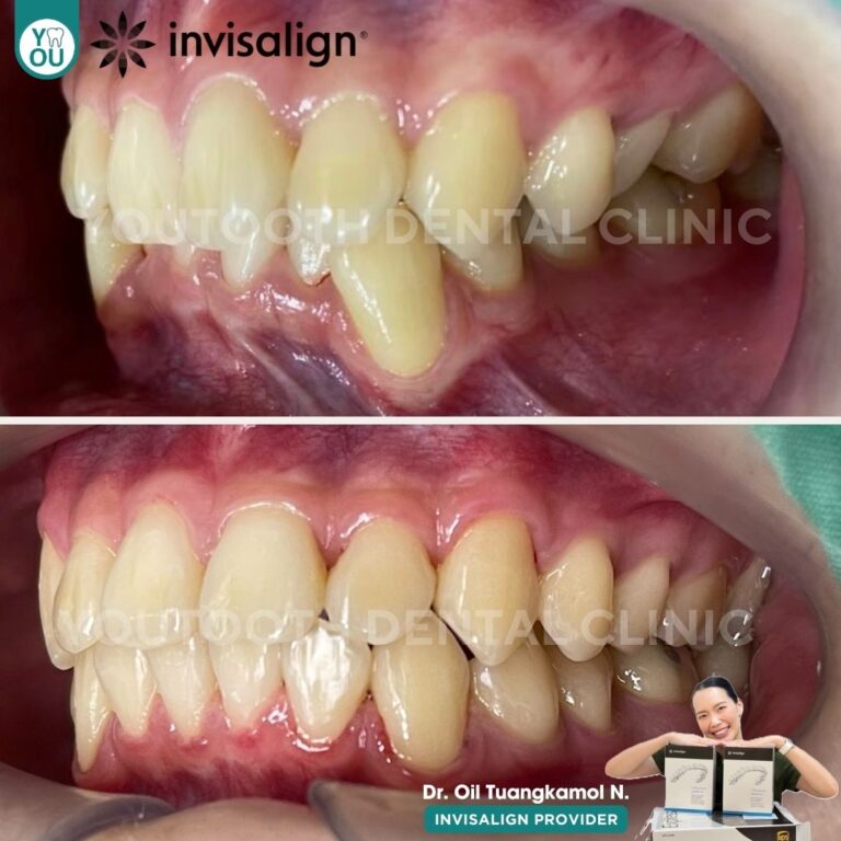 รีวิวจัดฟันใส invisalign