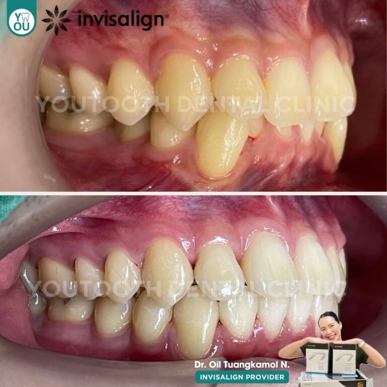 รีวิวจัดฟันใส invisalign