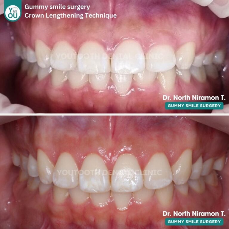 รีวิวการตัดเหงือก (Gum Contouring Surgery)