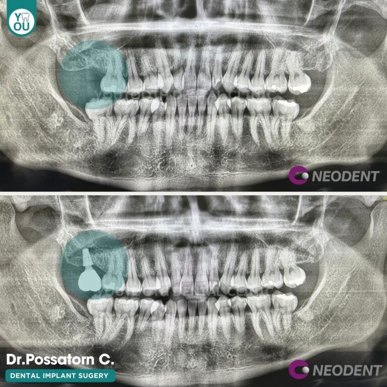 รีวิว รากฟันเทียม