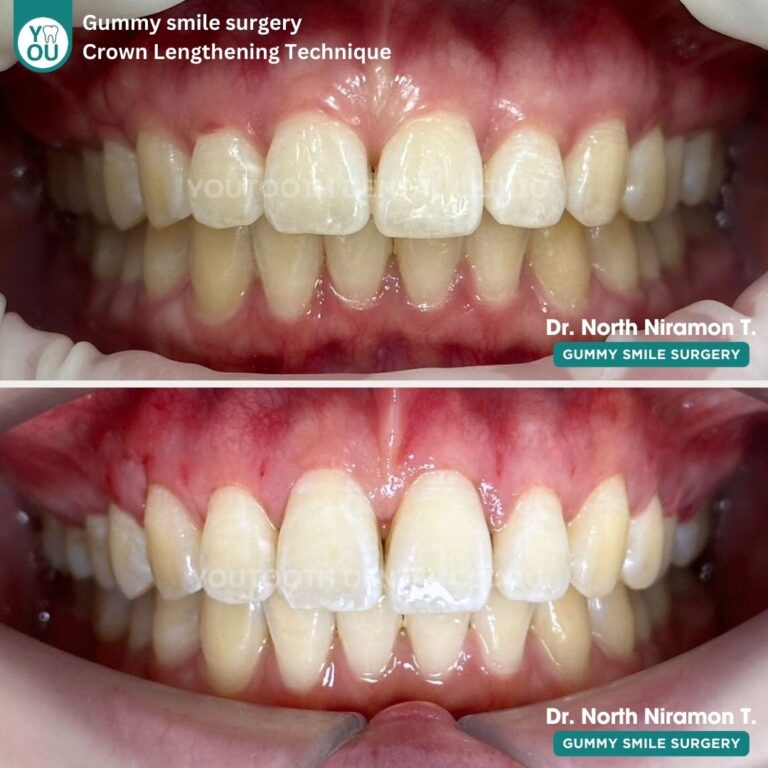 รีวิวการตัดเหงือก (Gum Contouring Surgery)