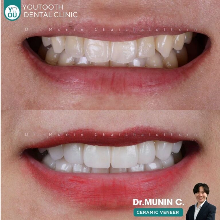 รีวิววีเนียร์