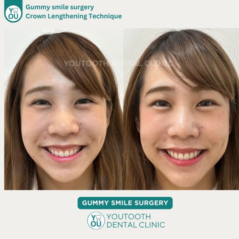รีวิวการตัดเหงือก (Gum Contouring Surgery)
