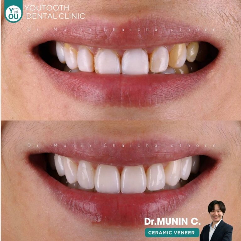 รีวิววีเนียร์