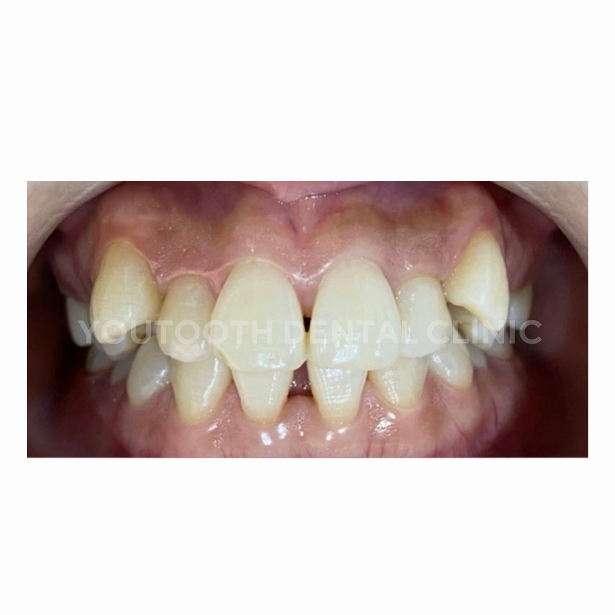Y1.1 Y1.1